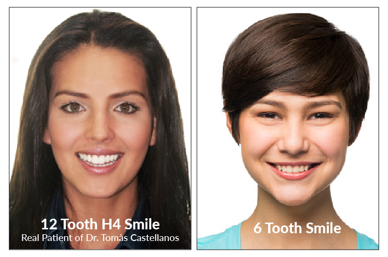 six vs twelve tooth smile